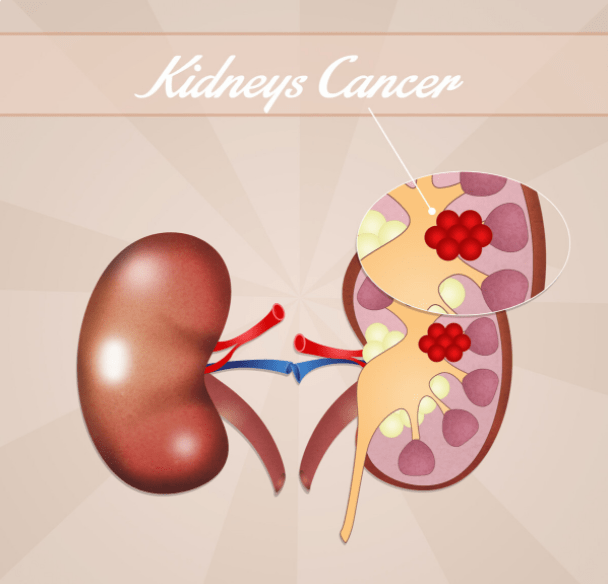 尿毒症|很幸运!4类肾友不会尿毒症,看看有你吗