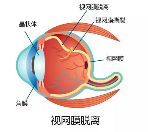 广元EYE小霸王|视网膜脱落的症状