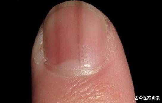 肝癌|肝癌大多是“等”出来的，身体出现3处“发黑”，没准肝已癌变，快查肝CT