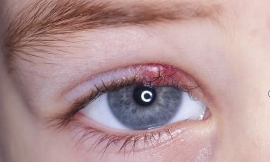 我是妈妈|孩子长了“针眼”,怎样才能消得快?医生提醒:千万不能用手挤