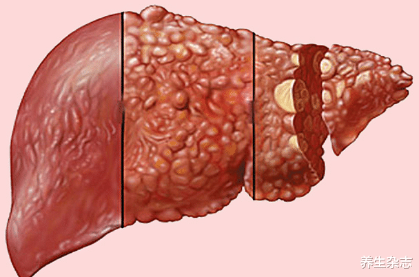 肝脏|身体2处“瘙痒”，八成是肝病，提醒：2种美食趁早忌口，忍住就是赢