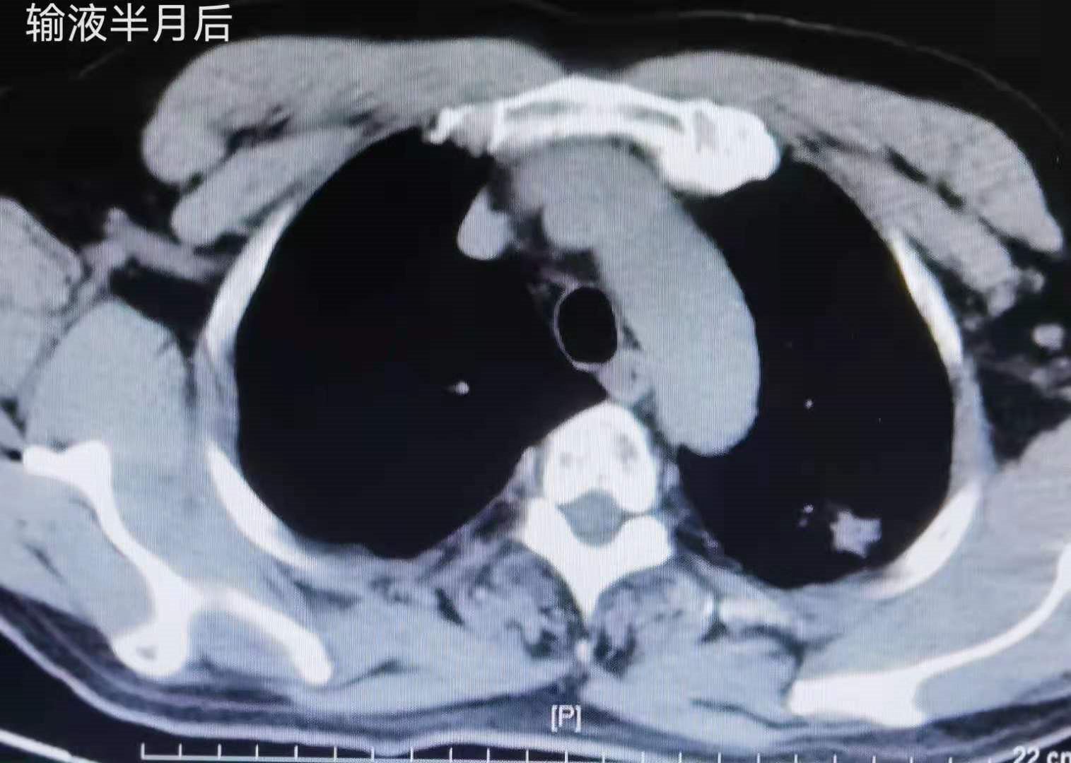 用户_胡洋|IB期肺癌术后患者未辅助治疗，达临床治愈