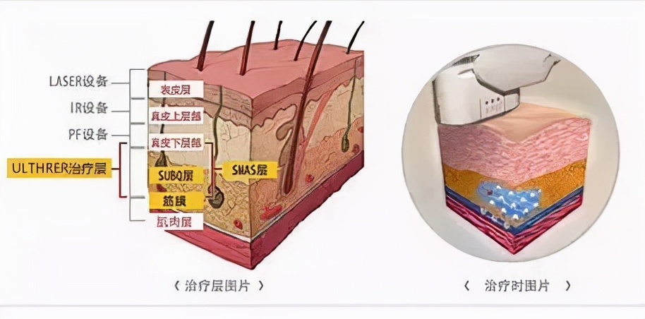 小美说美|超声刀有什么功效