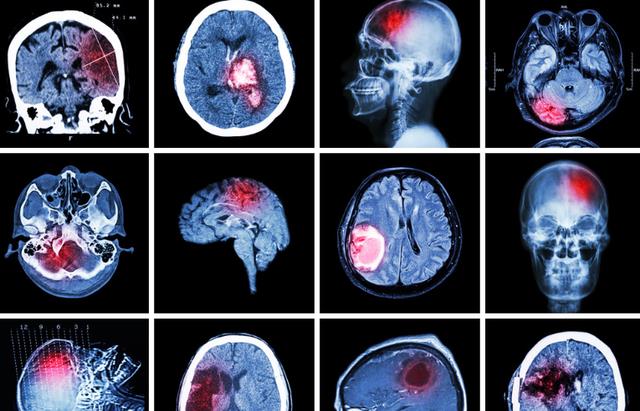 太阳系 为什么“磁共振”尽量不要做？或许你还不明白，与这3点有关系