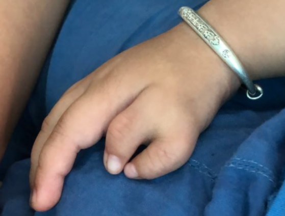 协和手足外科陈江海|拇指多指什么时候可以做手术？为什么会有多指？