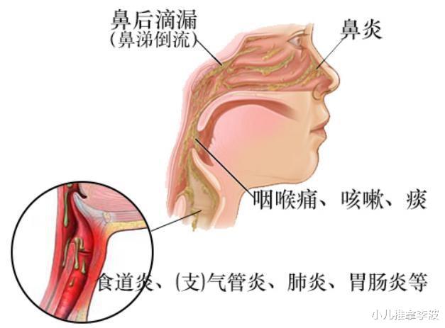 咳嗽|中医儿科李波:什么是儿童上气道咳嗽综合征?有啥表现,如何治疗
