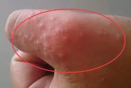 尿酸|手指上有了这种东西，说明你体内毒素可能堆积如山~
