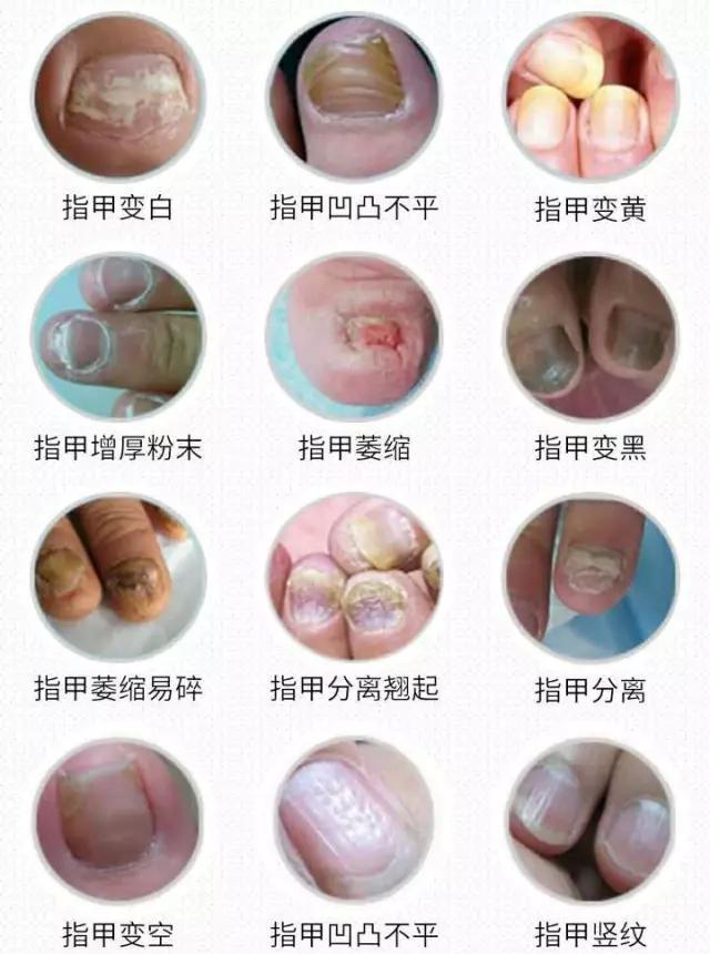清源净流|灰指甲治不好是什么原因?这些原因导致的灰指甲不好治!