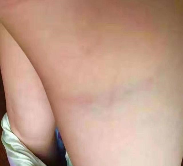 一座山岭 南京一小学生被班主任“殴打”致身体多处瘀斑，校方：正在处理中