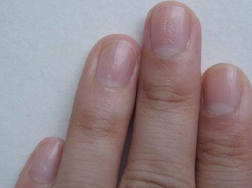 肝脏|指甲出现7个表现,肝脏可能出现了问题,请及时就诊检查!