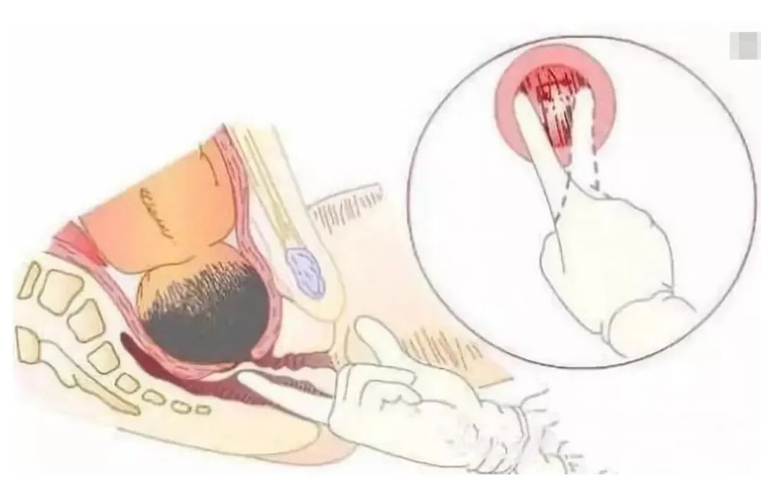 C妈学堂|分娩前，做内检到底是啥感觉？关于产前内检，今天一篇讲清楚