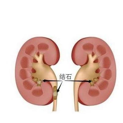 上海宏康|得了肾结石会出现哪些危害呢?