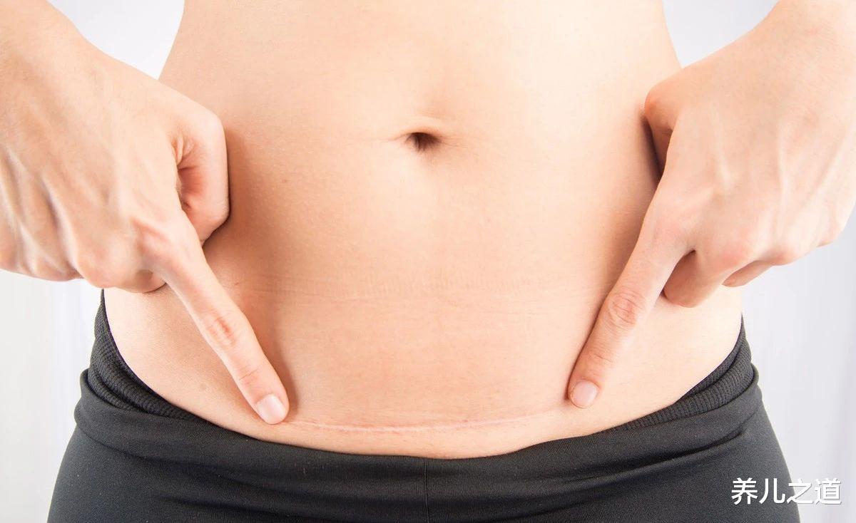 甲状腺结节|明明不是“疤痕体质”，但剖腹产后却很明显，说明与三点原因有关