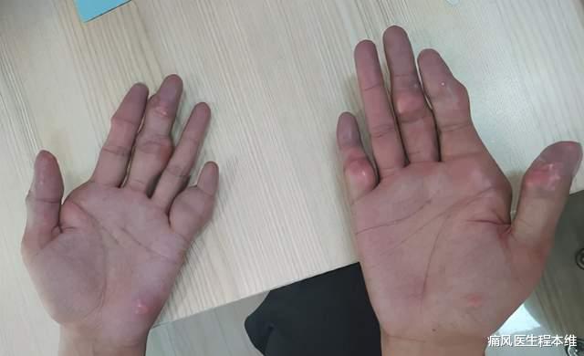 痛风医生程本维|痛风治不好别去治、别花钱，还遭罪【难道就不治了？！】