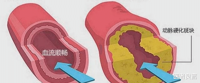 医者良言 血压到底看高压还是看低压?两者有什么区别吗?