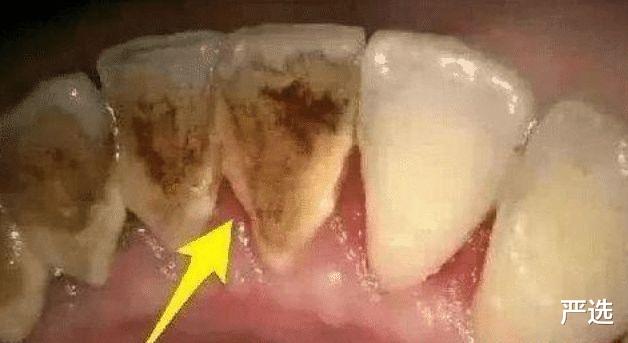 严选 牙缝里长出臭烘烘的“小石头”？学会小妙招，牙垢悄悄掉下来