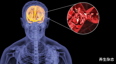 脑梗|22岁女大学生,突发脑梗,医生摇头:“1件事”做太多,不懂节制