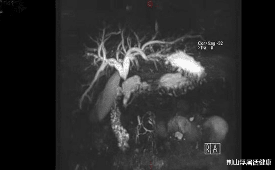 荆山浮屠话健康|肝脏长东西不要惊慌,恶性率并不高!一文带您了解,肝脏肿块有哪些?