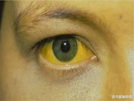 肝脏|院士直言:眼睛是肝脏的“报警器”,一旦有这4种异常,及时做肝CT