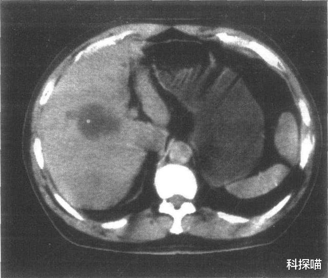 体检|体检时查出这5种病,或无需过度治疗,不要自己吓唬自己!
