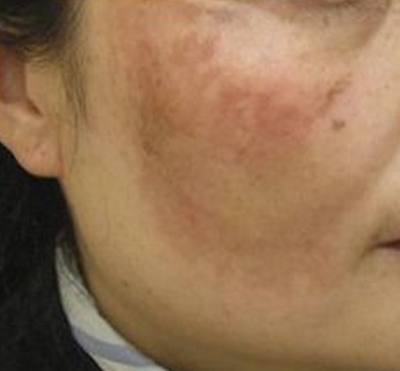 燃染冉|只有老年人才会长斑？大错特错！长斑该怎么预防或淡化？ 你是不是觉得只有上了年纪的人才会长斑？