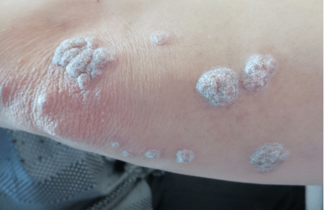 小杰啊啊 医生提醒：宫颈有癌，双腿会有2处变化，应尽快去检查HPV