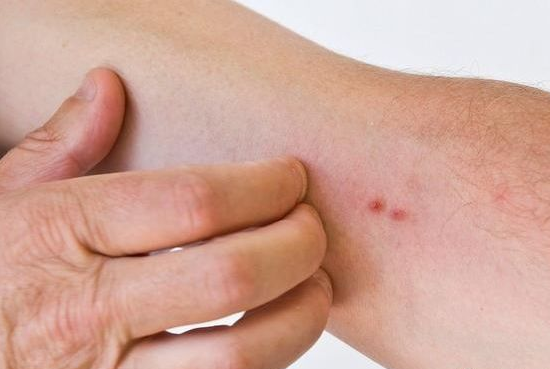 肝硬化|45岁农民工以为皮肤过敏，确诊肝硬化，医生：身上2处发痒，早做检查