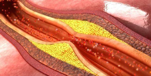 铠甲护士 甘油三酯偏高的人，日常可以多吃这3种食物！