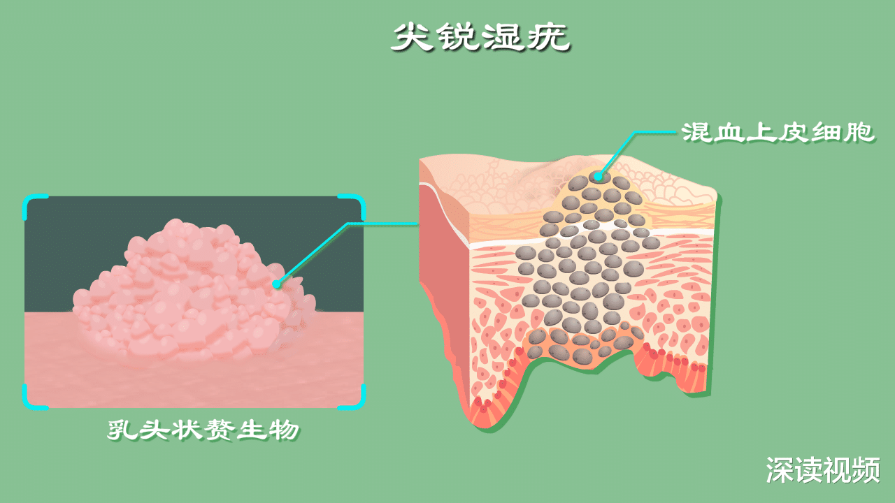 深读视频 明明没出轨，为啥染上尖锐湿疣？还有哪些你不知道的事会招惹HPV？