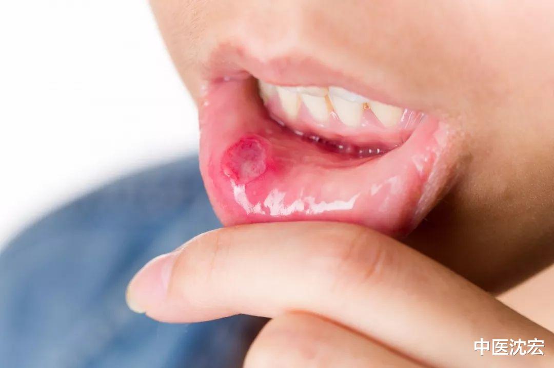 口腔溃疡|口腔溃疡，其实问题不在口腔，一味中药，止痛、化瘀，立马见效