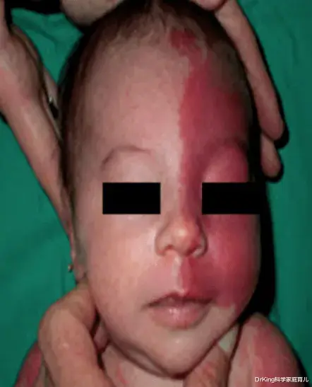 DrKing科学家庭育儿|听过100种胎记的传说,有人告诉你这几种胎记可致命吗?