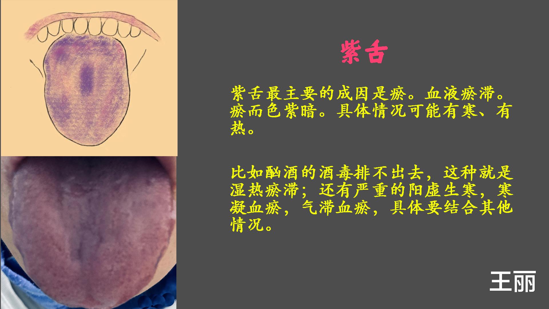 |中医：小小舌头，大有乾坤；认识几种常见的经典舌头，带详细图解