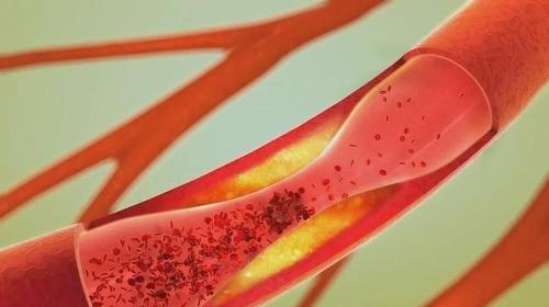 体检|医生眼里的6种“善良瘤”，确诊后先别慌，恶化概率很低