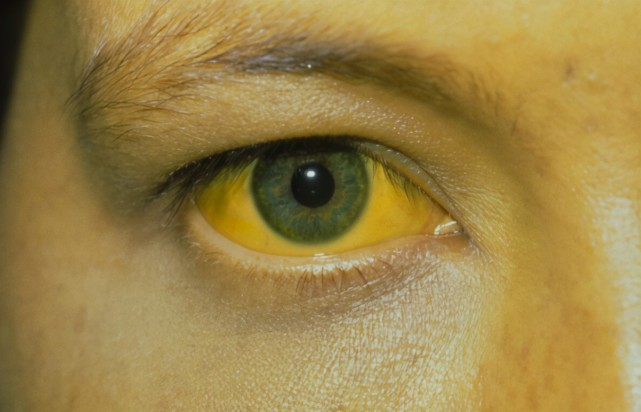 雪雪的鱼|28岁男子确诊肝癌！内科医生：脸上出现3种表现，别装看不见