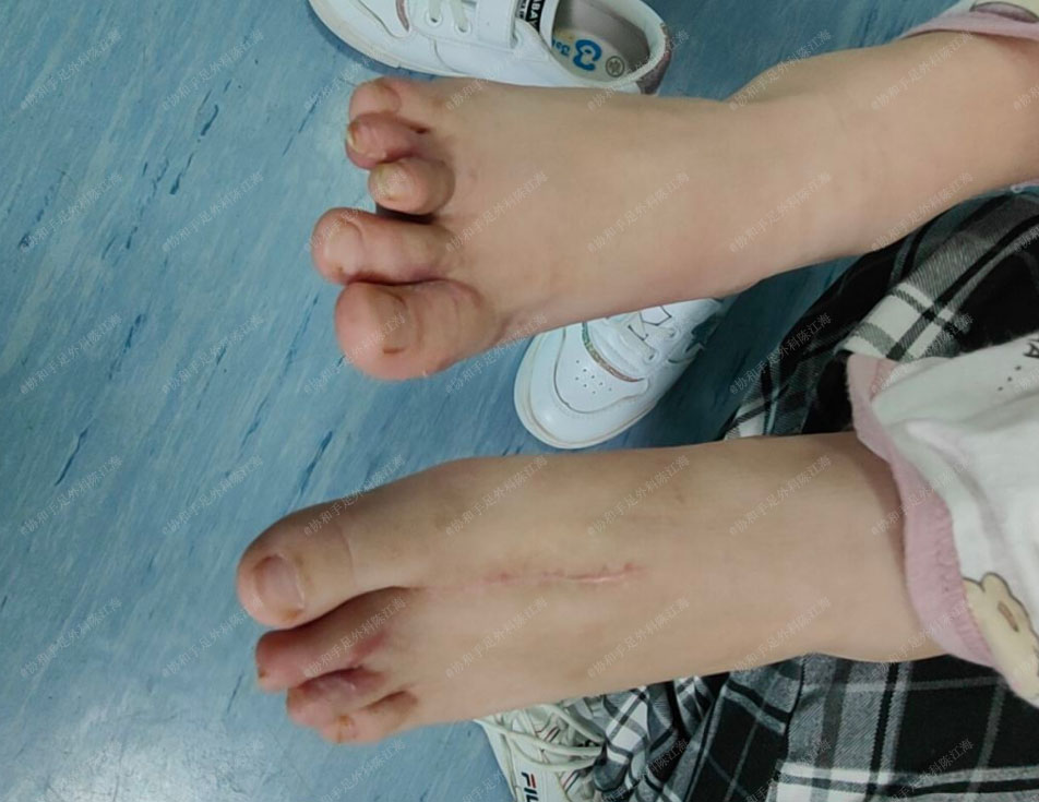 协和手足外科陈江海 这位孩子走路脚不受力，走不稳，是不是有什么问题？
