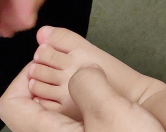 协和手足外科陈江海|宝宝多趾什么时间做手术比较好？手术需要全麻吗？