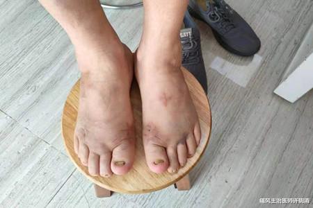 痛风主治医师许明清|都说痛风不致命，但这次也许是你错了