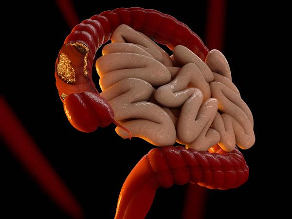 便秘|肠癌来临时,身体这4个迹象很明显,发现一个也要重视起来!