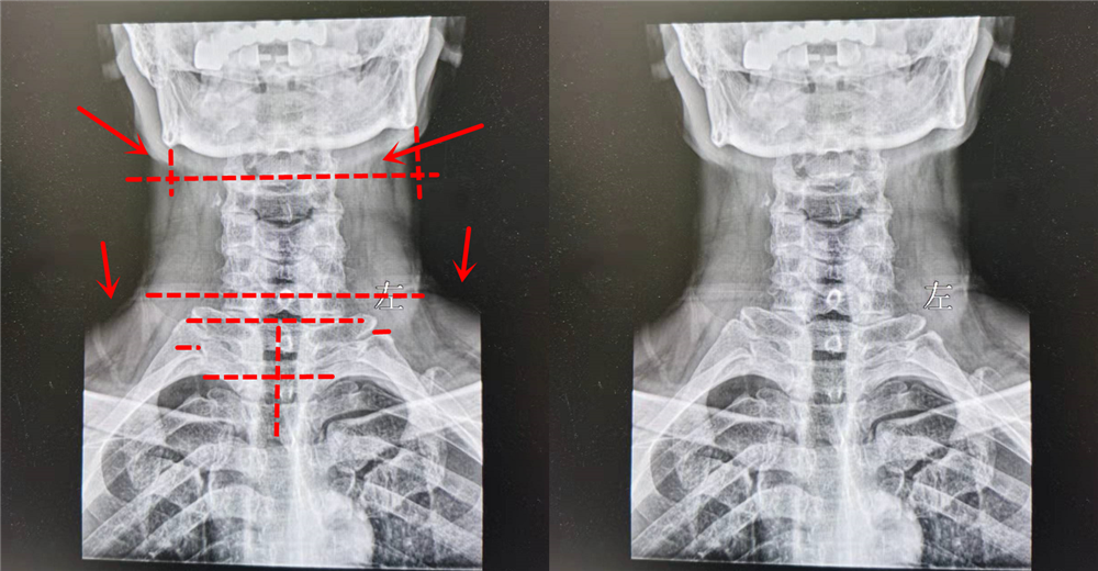 高血压|29岁颈源性高血压患者!低龄化发病人群该如何注意身体
