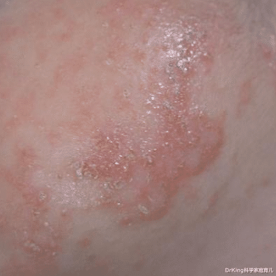 DrKing科学家庭育儿|娃爱长痱子,多少“粉和水”都没用!止痒、消肿,专家支3招!
