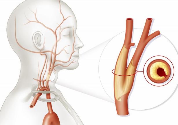 牙齿|年过40岁后,“颈动脉”要保护好,坚持以下4点,守护血管健康!