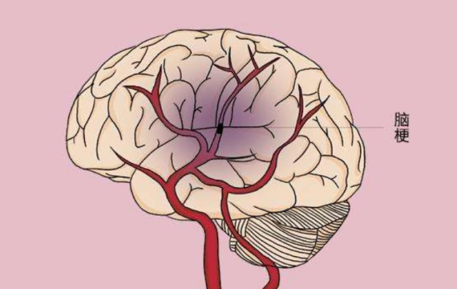 脑梗|血脂偏高时，身体隐约出现3种“异常”，别拖到脑梗才重视