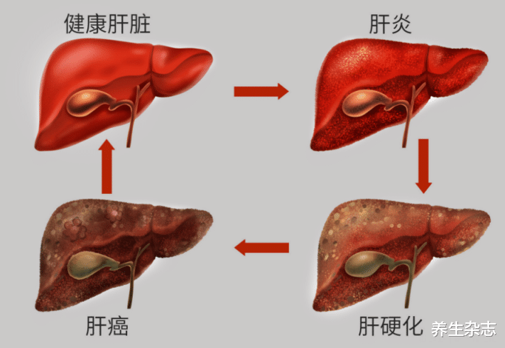 羊肉|羊肉是肝病的“发物”?医生:不止羊肉,这3种“肉”少吃,肝才更健康