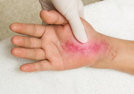 血糖|判断自己的血糖高不高，不妨看下手上有无这5个表现，早做了解