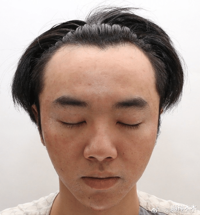 整容|扒一扒改头换面的男星们，有人“无痛变帅”，有人“整容过猛”