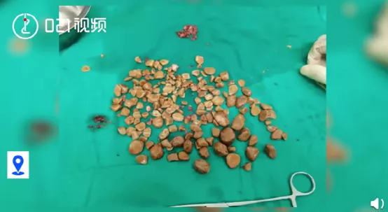 膀胱结石|你永远都不知道，结石会从哪个部位长出来
