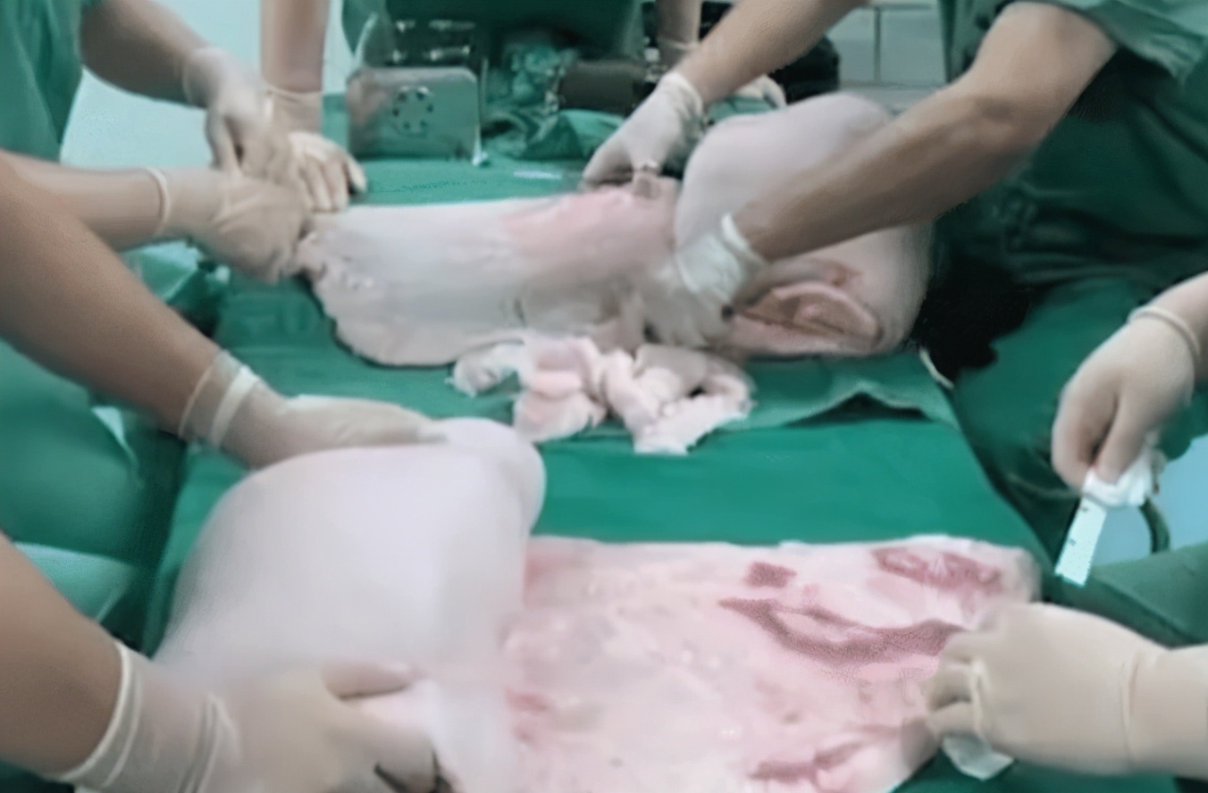 亚洲播报一姐 河南一男子皮肤烧伤，医生用猪皮植皮，称：长不了毛