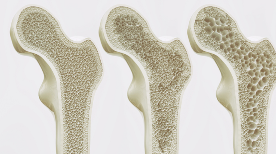 |骨质疏松的“祸首”被揪出，提醒：忌口3物，多做4事，骨松悄悄不见了