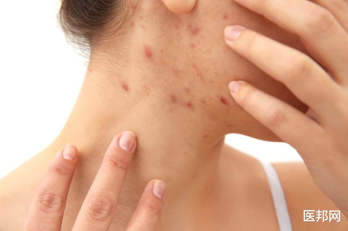 痤疮|成年老痘坑还有救吗?嫌难看,可以考虑这样治疗