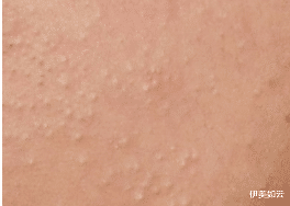 伊美如云|粉刺总会在意想不到的时候出现，一定要避免这些坑